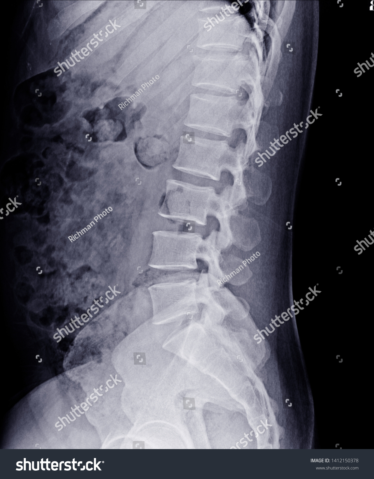 Xray Lsspine Lateral Views Normal Lumbosacral Foto De Stock 1412150378 Shutterstock