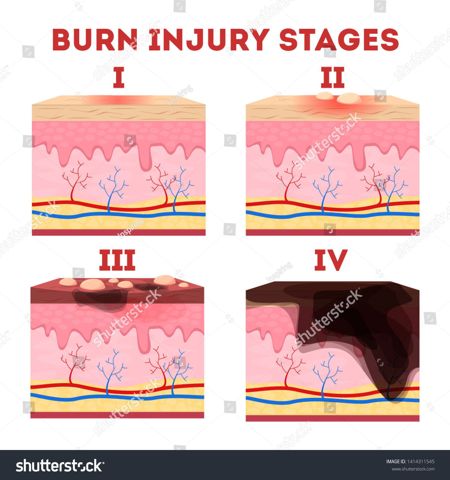 Skin Burn Injury Stages Anatomy Skin Stock Vector (Royalty Free ...