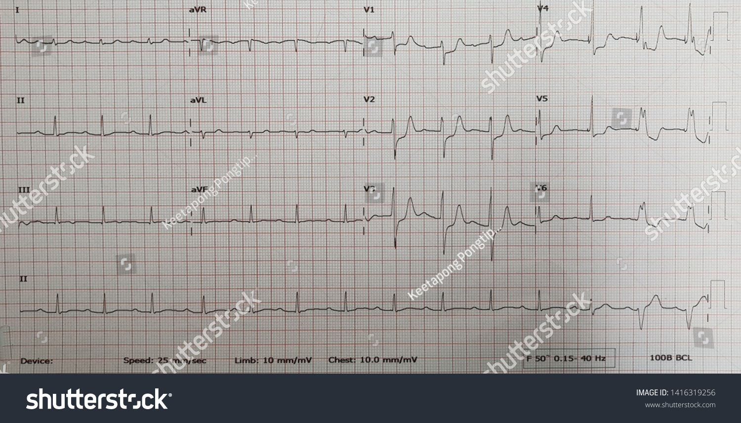 Стоковая фотография 1416319256: Posterior Wall Stemi 1st Degree Av ...