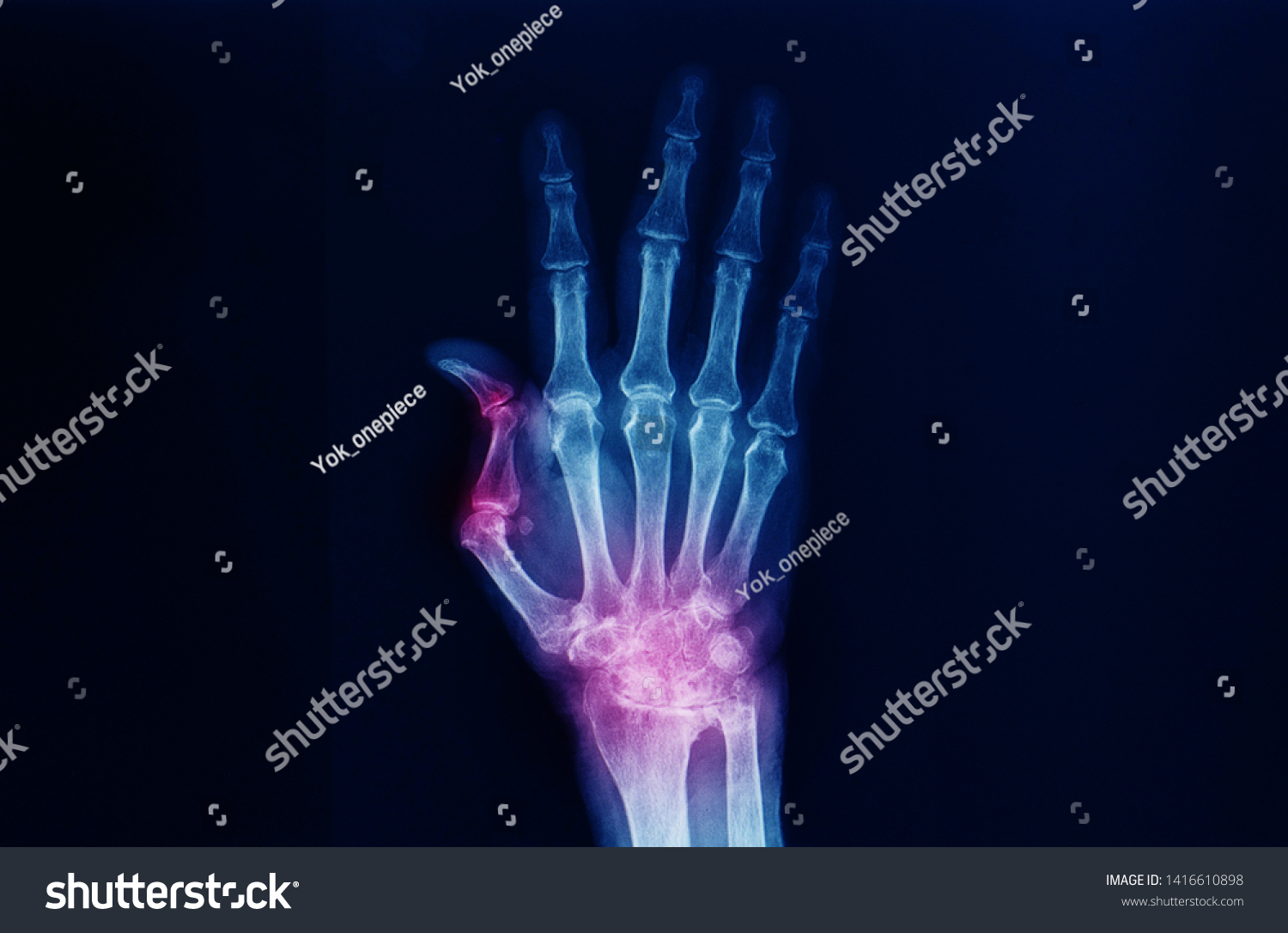 Hand Wrist Xray Showing Severe Arthritis Stock Photo 1416610898 ...