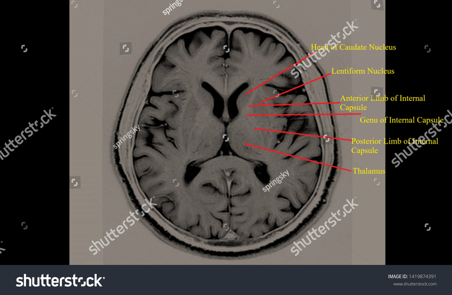 Ilustrasi Stok Basal Ganglia Annotated Structures Brain Mri 1419874391 ...