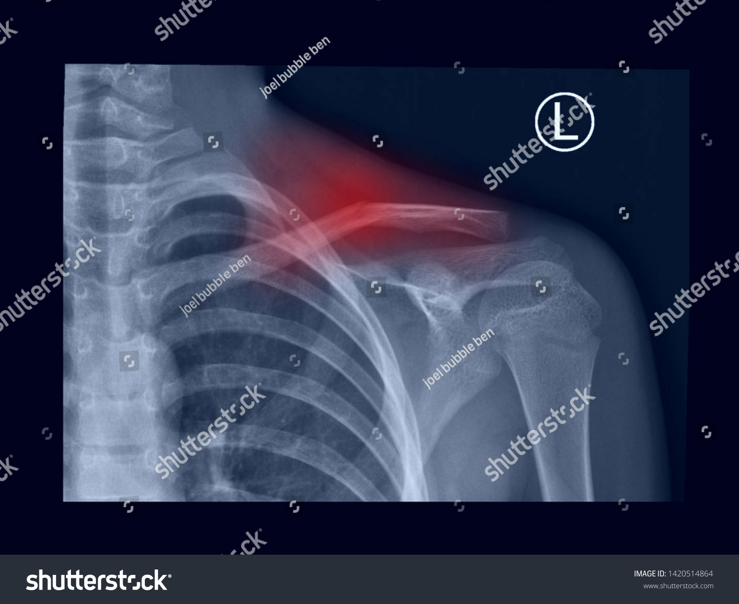 Film Xray Shoulder Radiograph Show Fracture Stock Photo Shutterstock