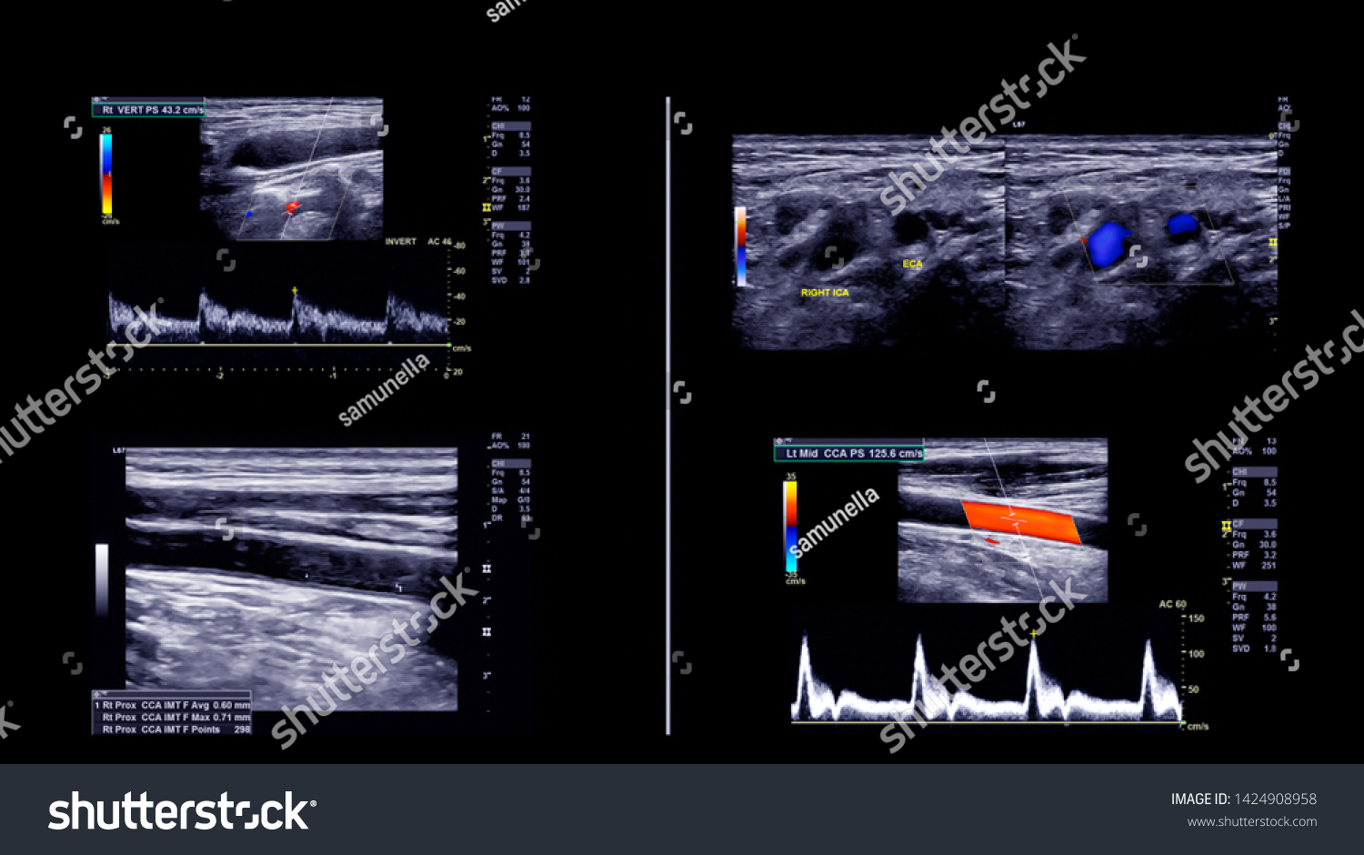 Ultrasound Doppler Finding Deep Vein Thrombosis Stock Photo 1424908958 ...