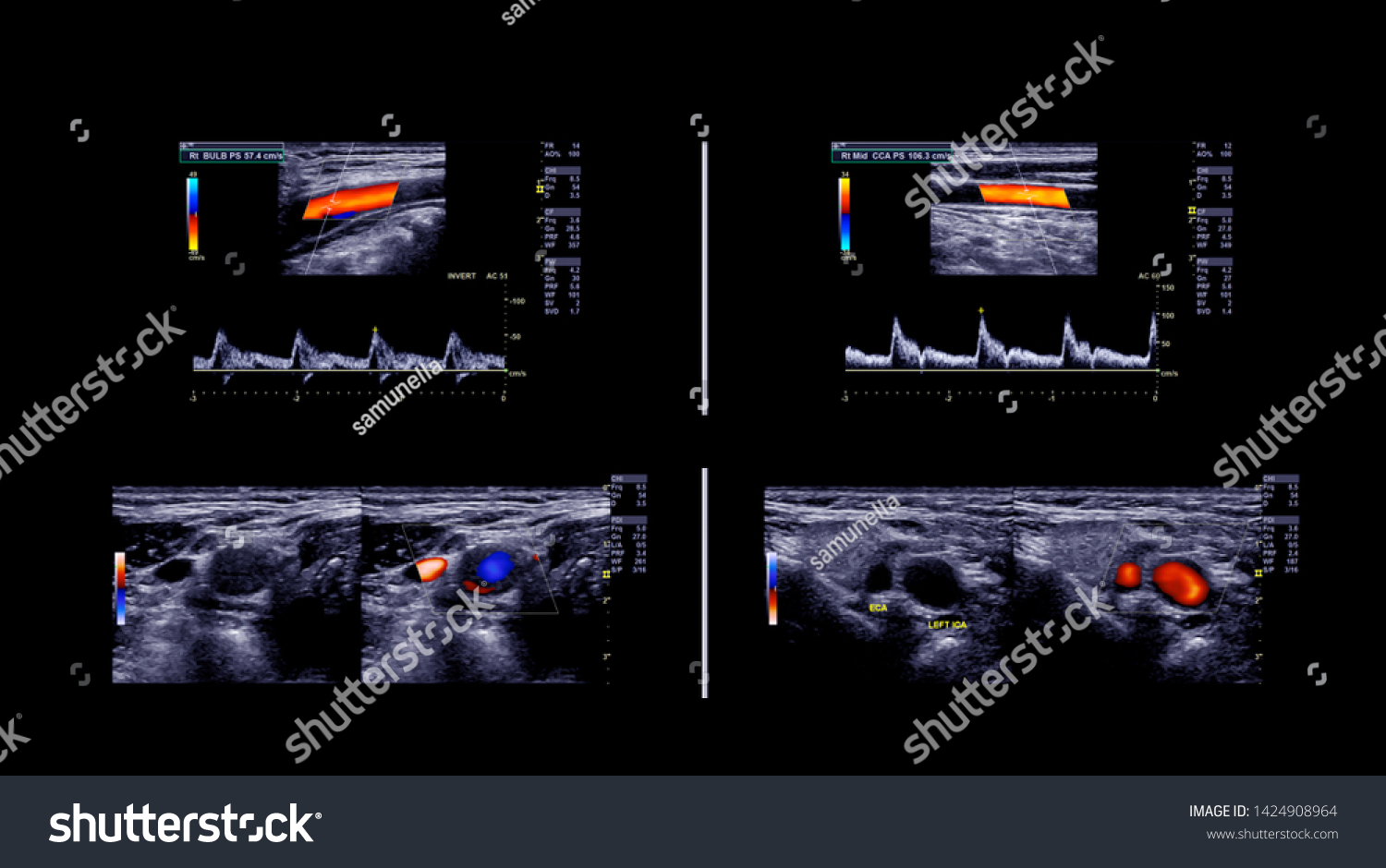 Ultrasound Doppler Diagnosis Deep Vein Thrombosis Stock Photo ...