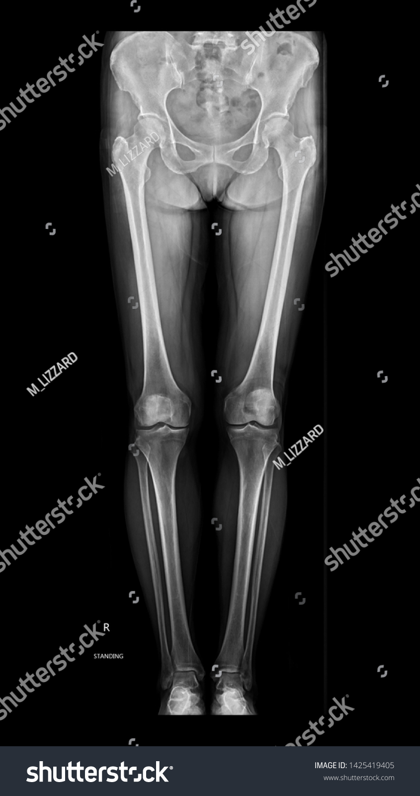 Xray Whole Leg Lower Extremity Scanogram Shutterstock