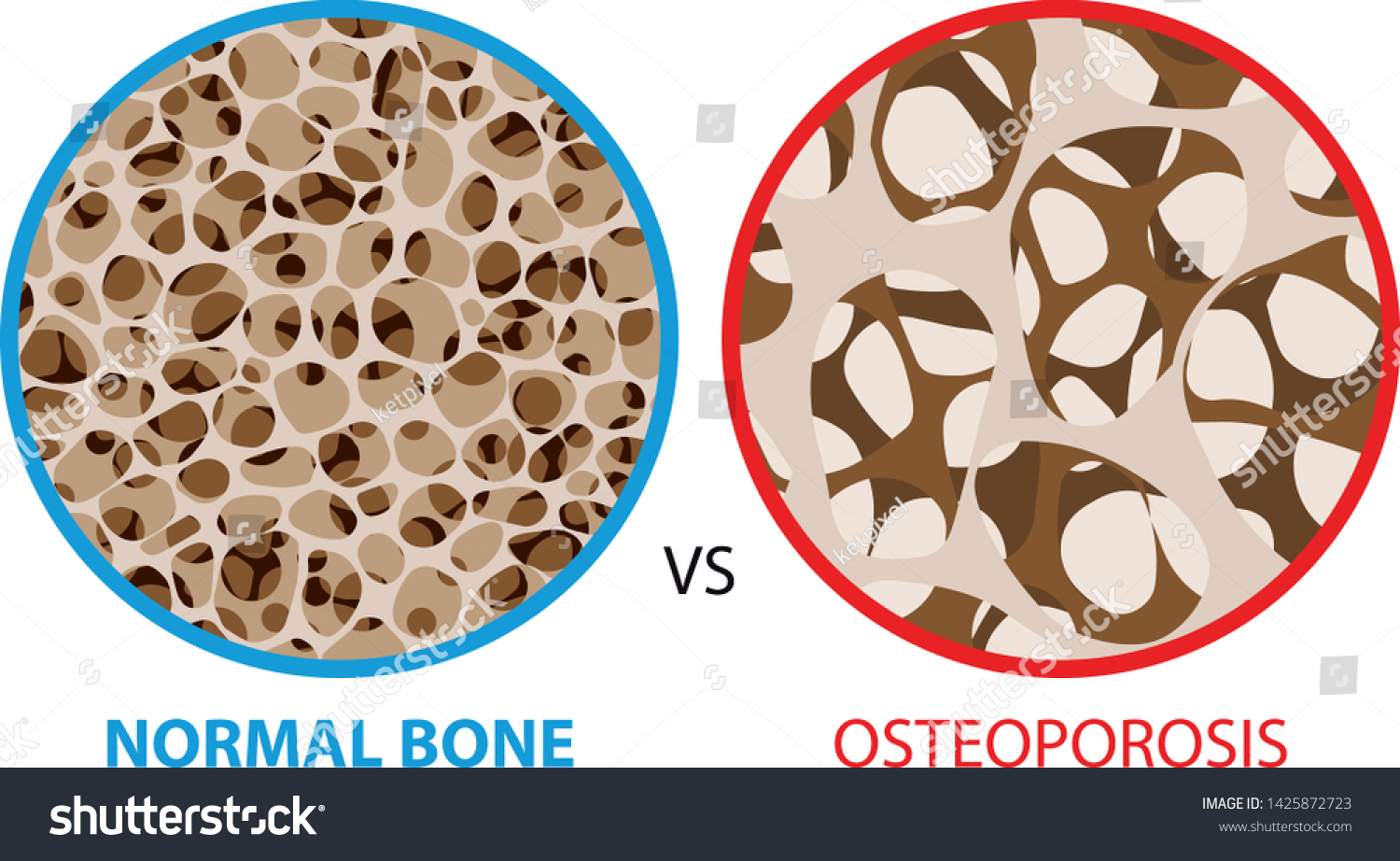 Normal Bone Versus Osteoporosis Bone Spongy Stock Vector (Royalty Free ...