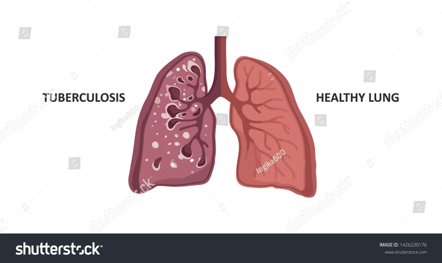 Healthy Lung Lung Infected Tuberculosis Stock Vector (royalty Free 