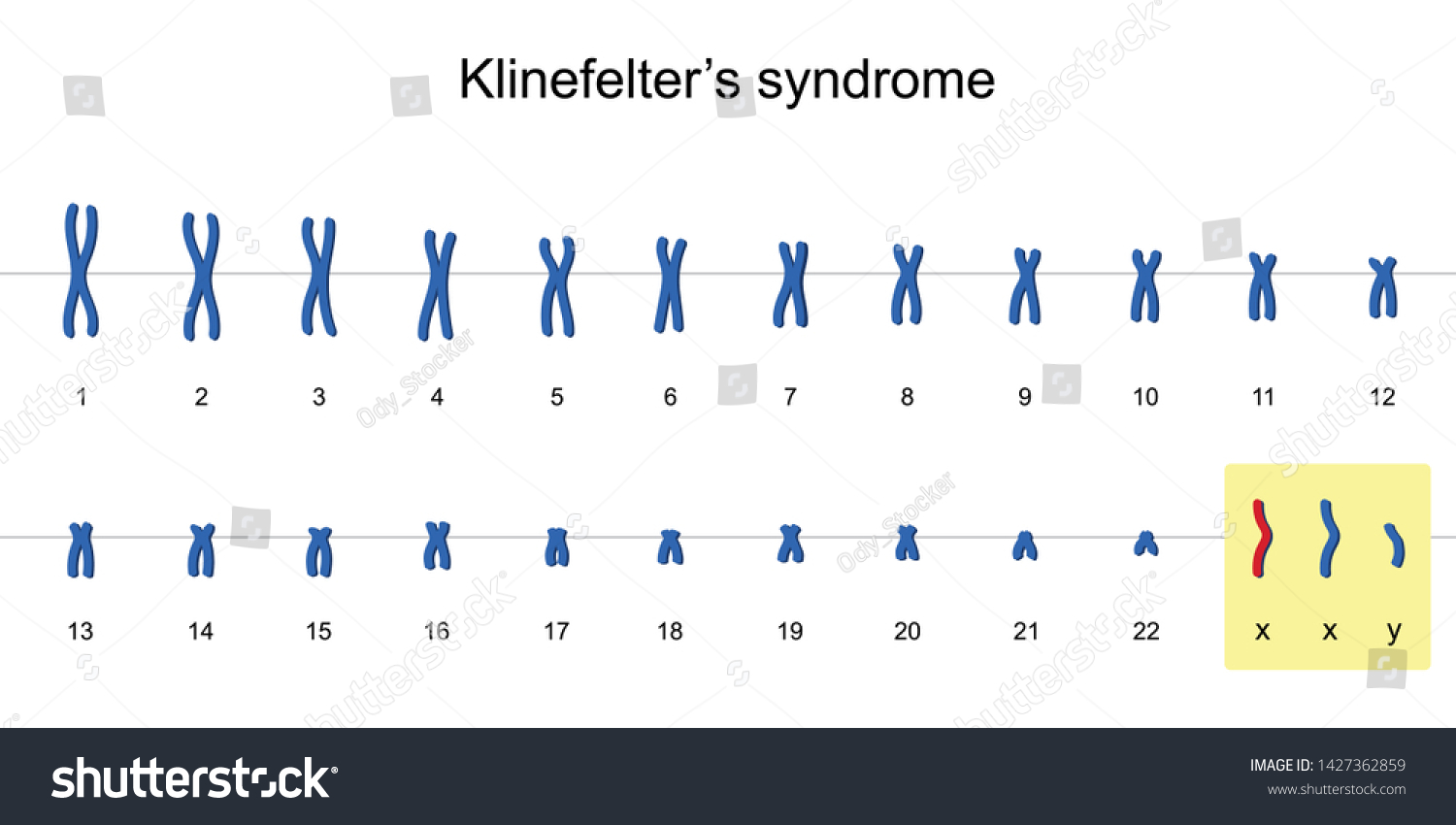 Klinefelters Syndrome Karyotype Nondisjunction Sex Chromosomes Stock Vector Royalty Free 