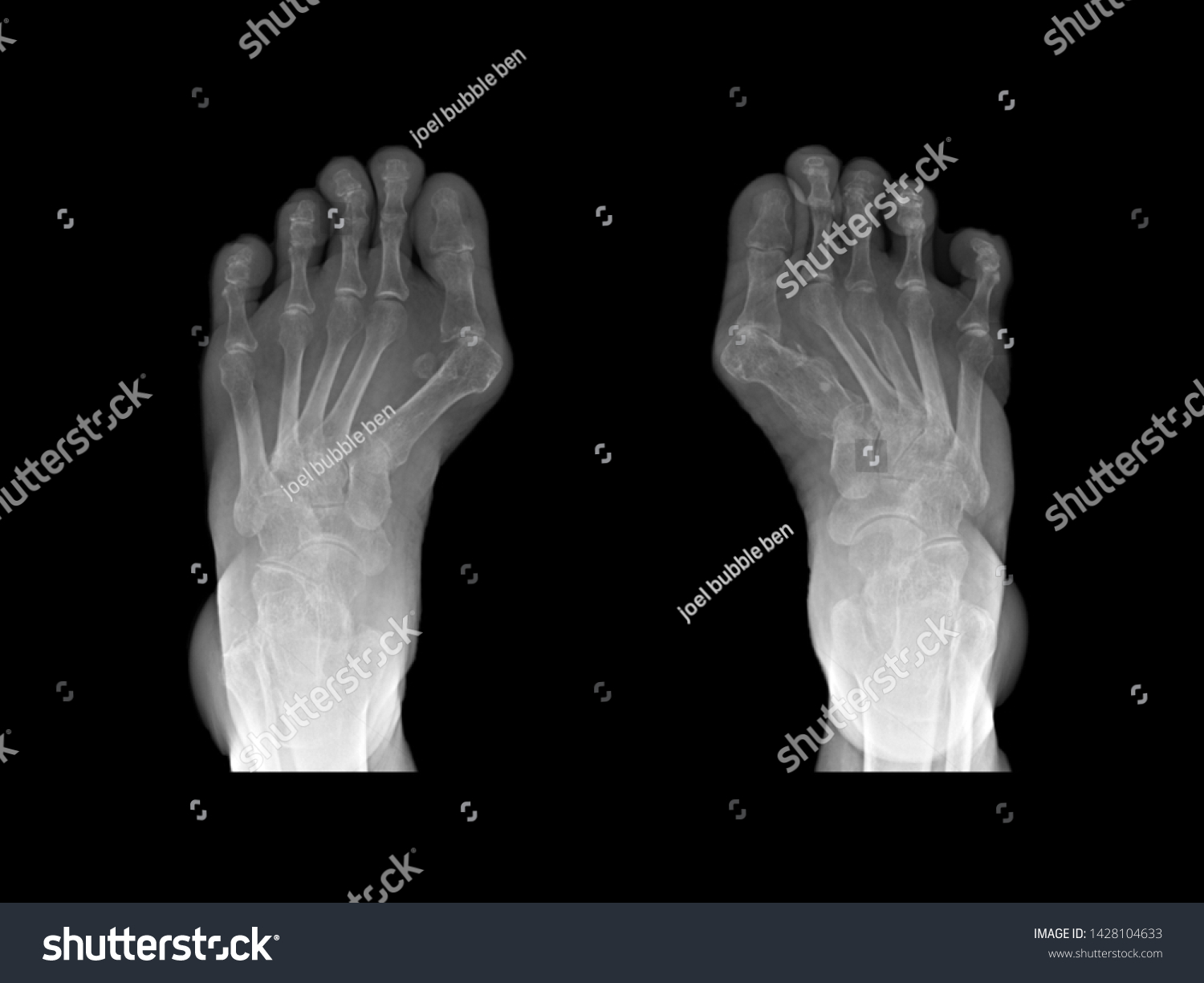 Film Xray Foot Radiograph Show Both Stock Photo 1428104633 | Shutterstock