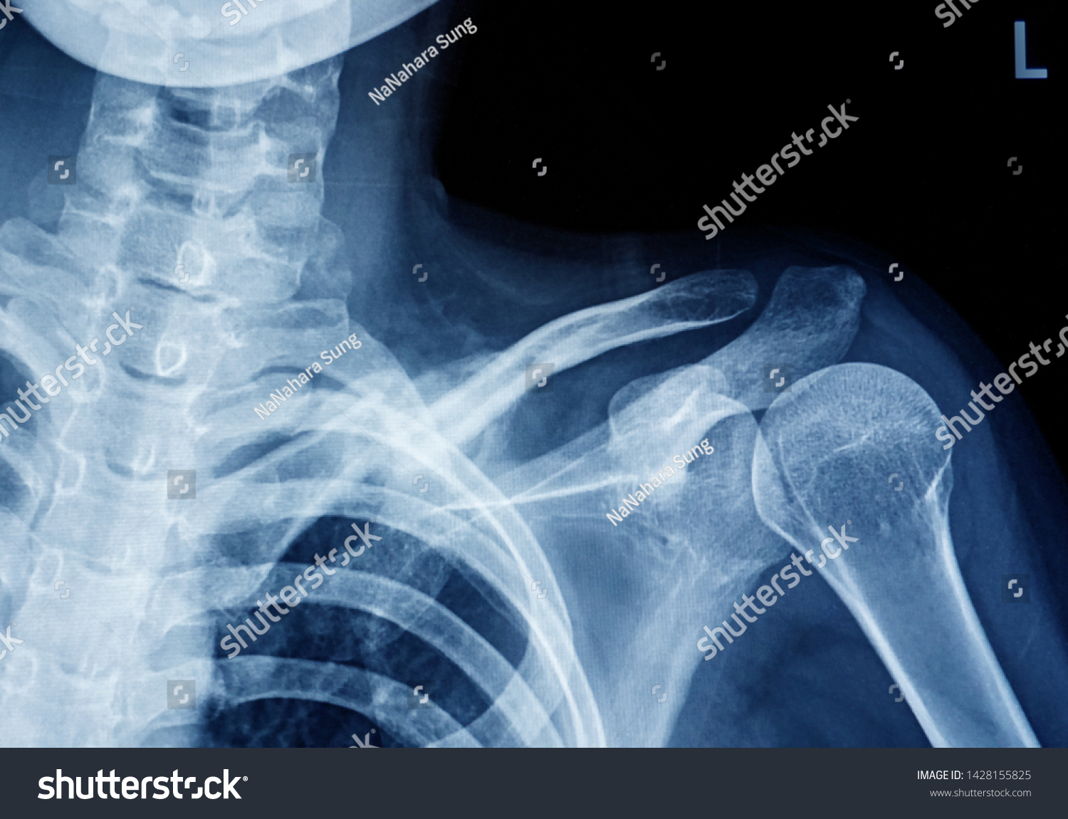 Xray Shoulder Joint Show Clavicle Stock Photo Shutterstock