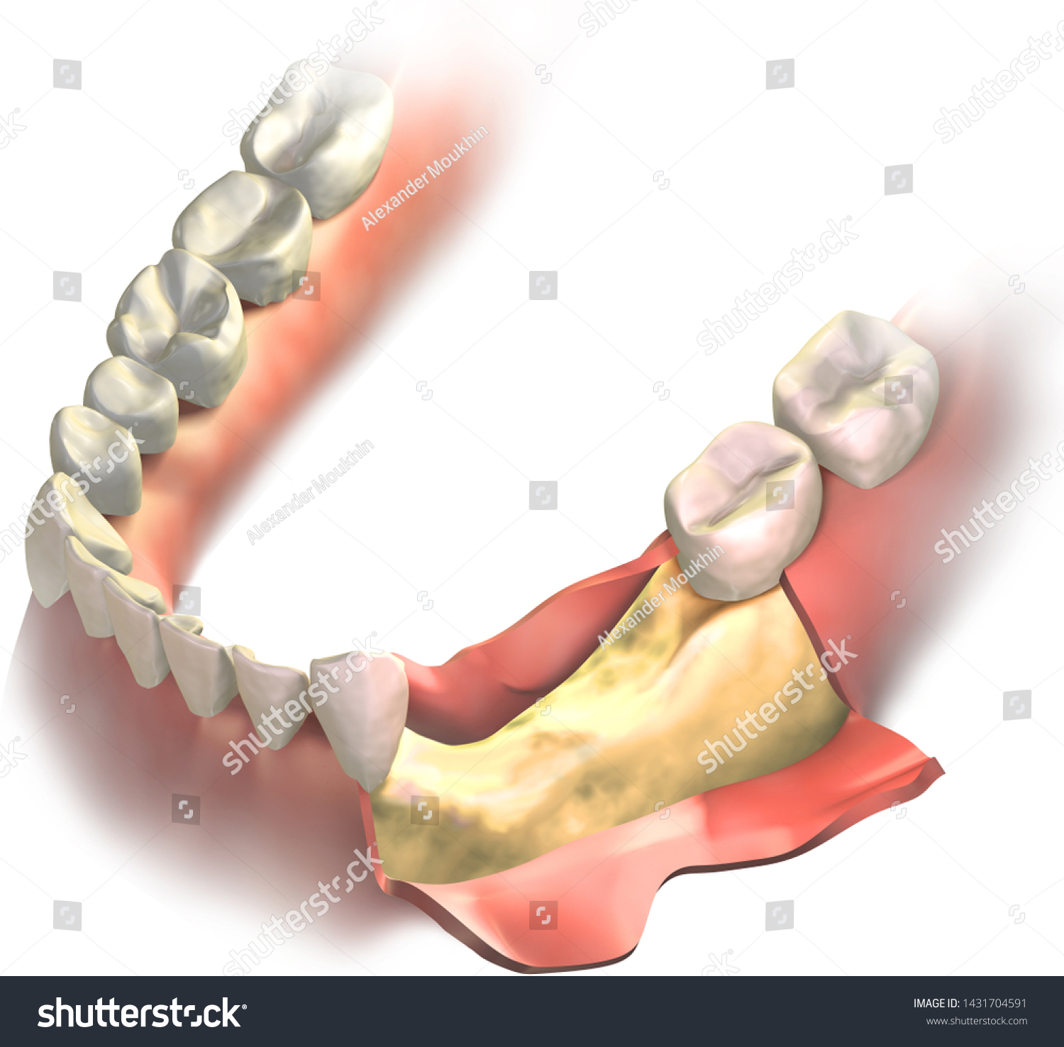 Bone Loss On Lower Jaw Opened Stock Illustration 1431704591 | Shutterstock