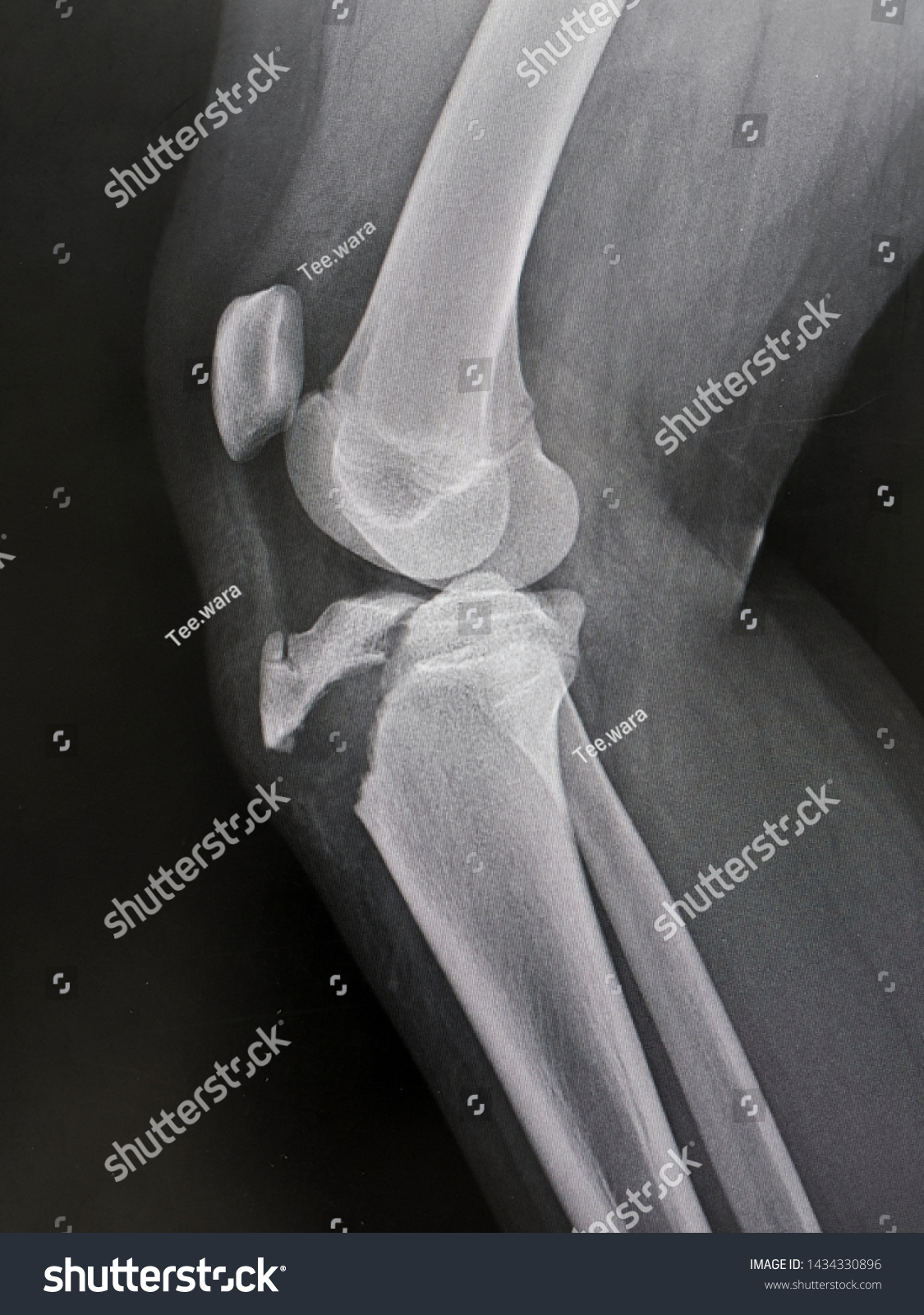 This Xray Show Avulsion Fracture Proximal Stock Photo 1434330896 ...