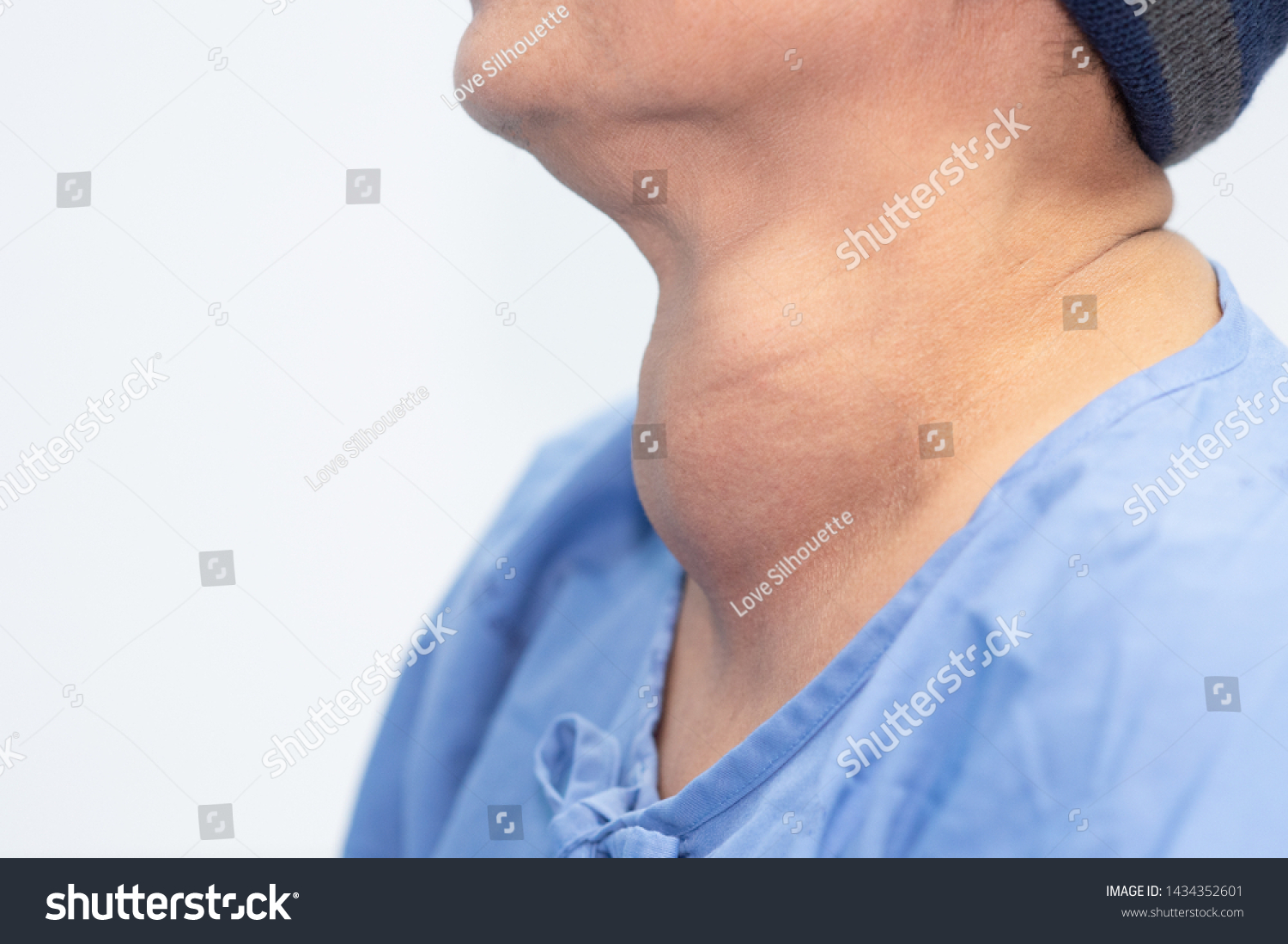 Photo De Stock Un Goitre Thyroïdien Multi Nodulaire élargi Chez