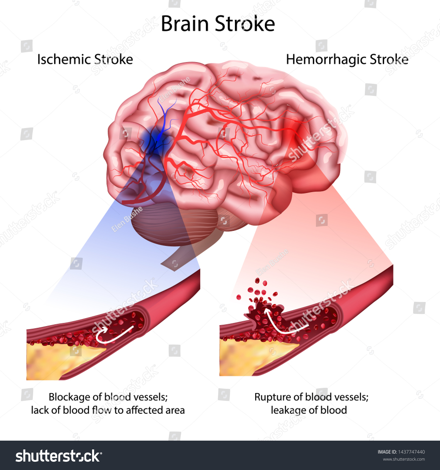 Stroke Types Poster Banner Medical Illustration Stock Illustration 