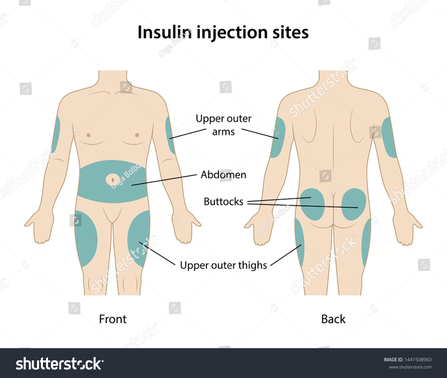 Места инъекций инсулина