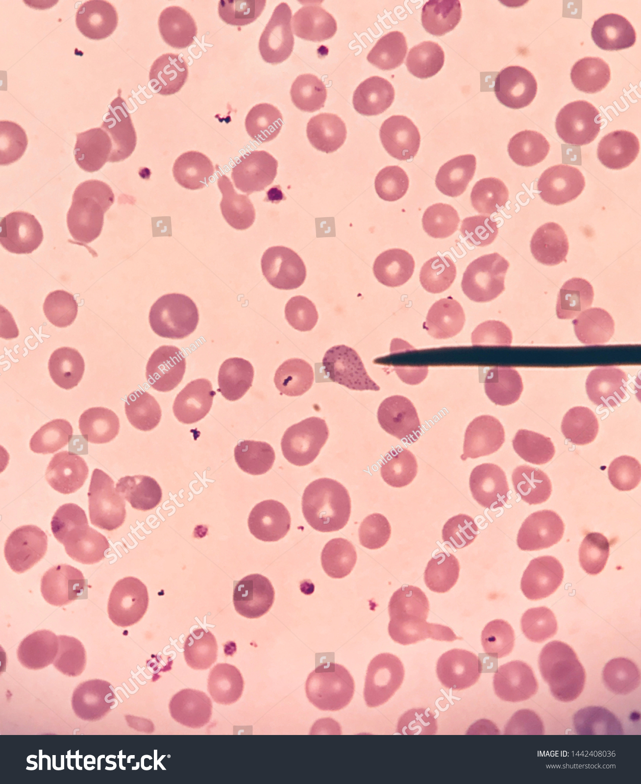 basophilic stippling thalassemia