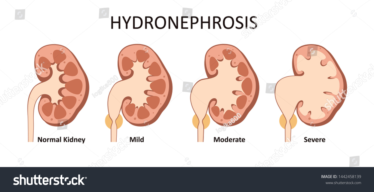 Hydronephrosis Stage Classification Vesicoureteral Reflux Stock ...