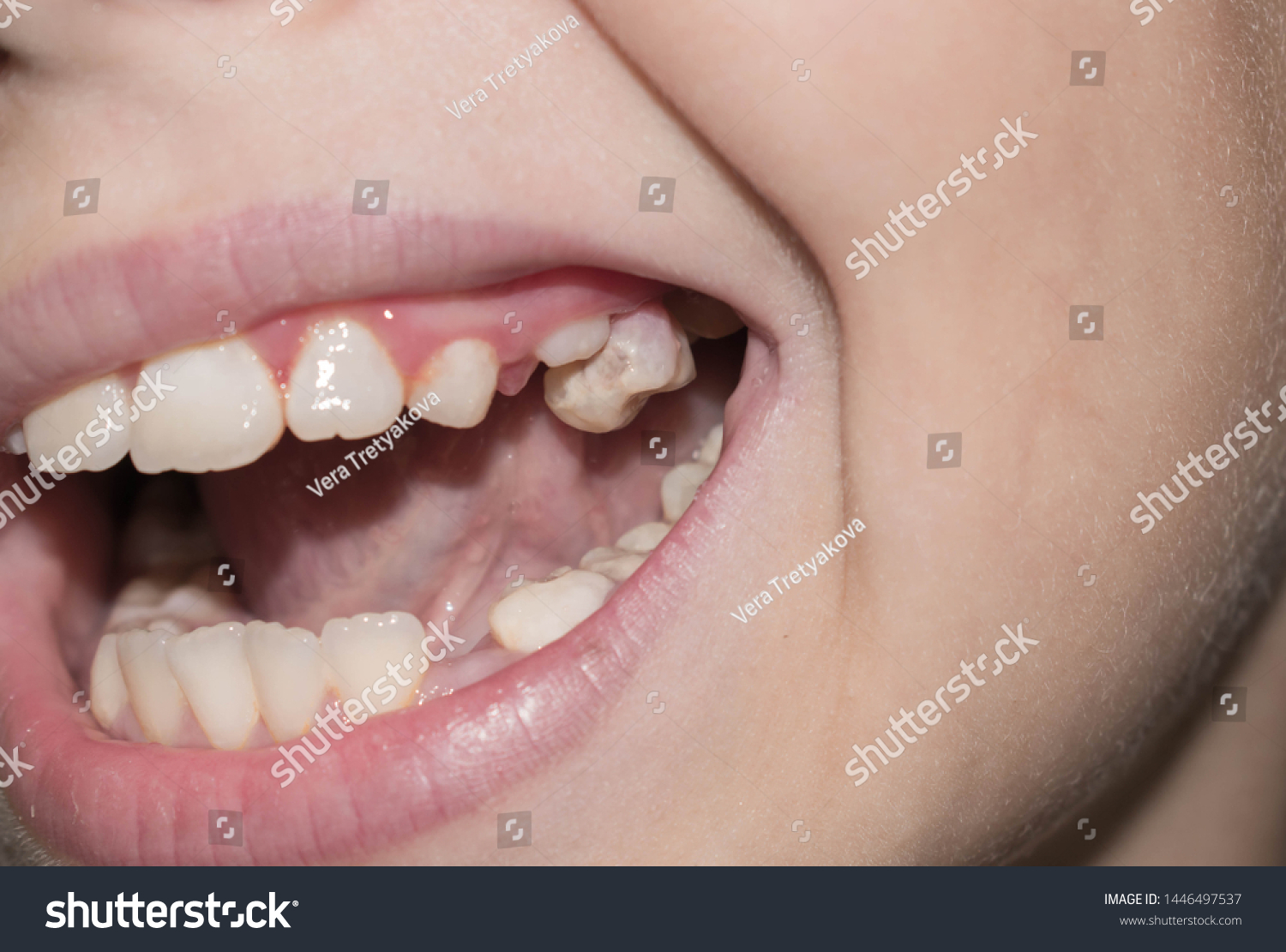Primary Milk Teeth Fall Out Break Stock Photo 1446497537 | Shutterstock