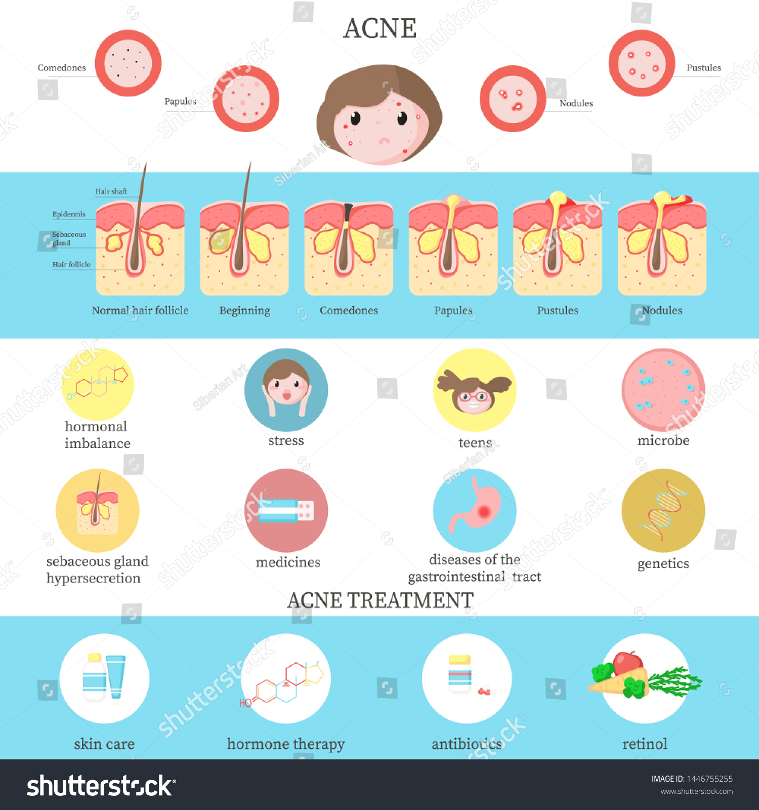 Acne Types Causes Treatment Infographics Flat Stock Illustration ...