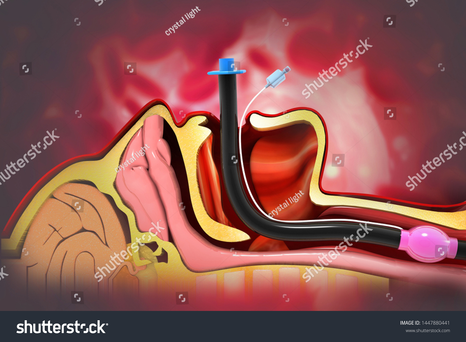 Endotracheal Intubation On Scientific Background 3d Stock Illustration ...