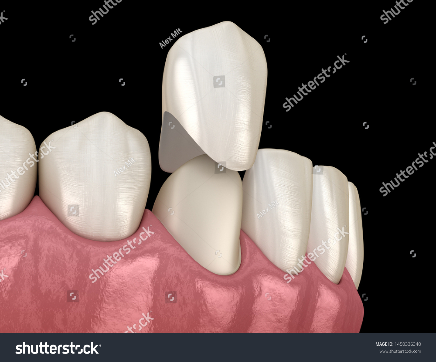 Preparated Canine Tooth Dental Crown Placement Stock Illustration ...