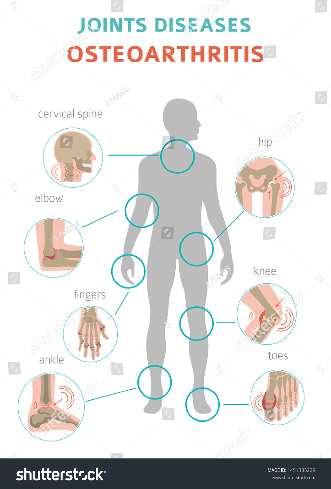 Arthritis Osteoarthritis Medical Infographic Design Joint Stock Vector ...