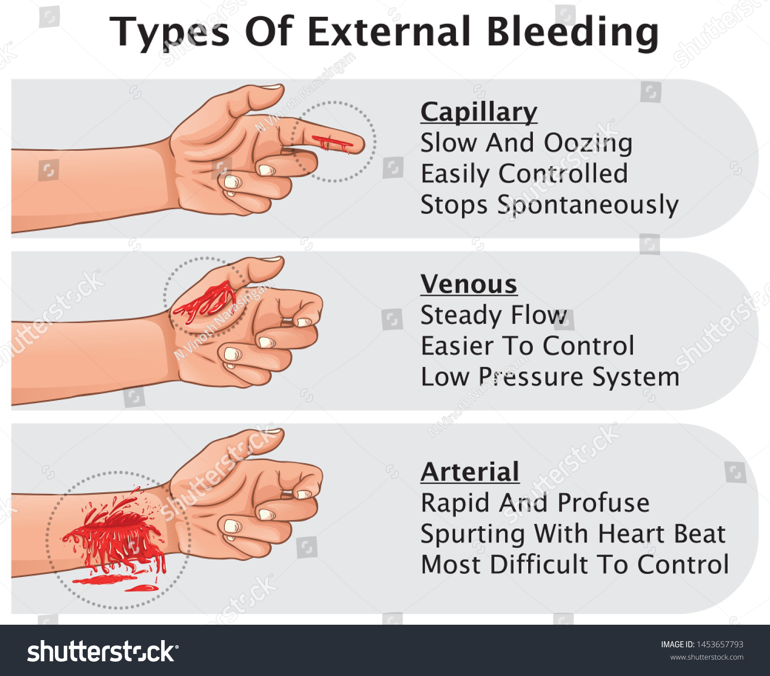 three-types-external-bleeding-hemorrhage-classification-stock-vector