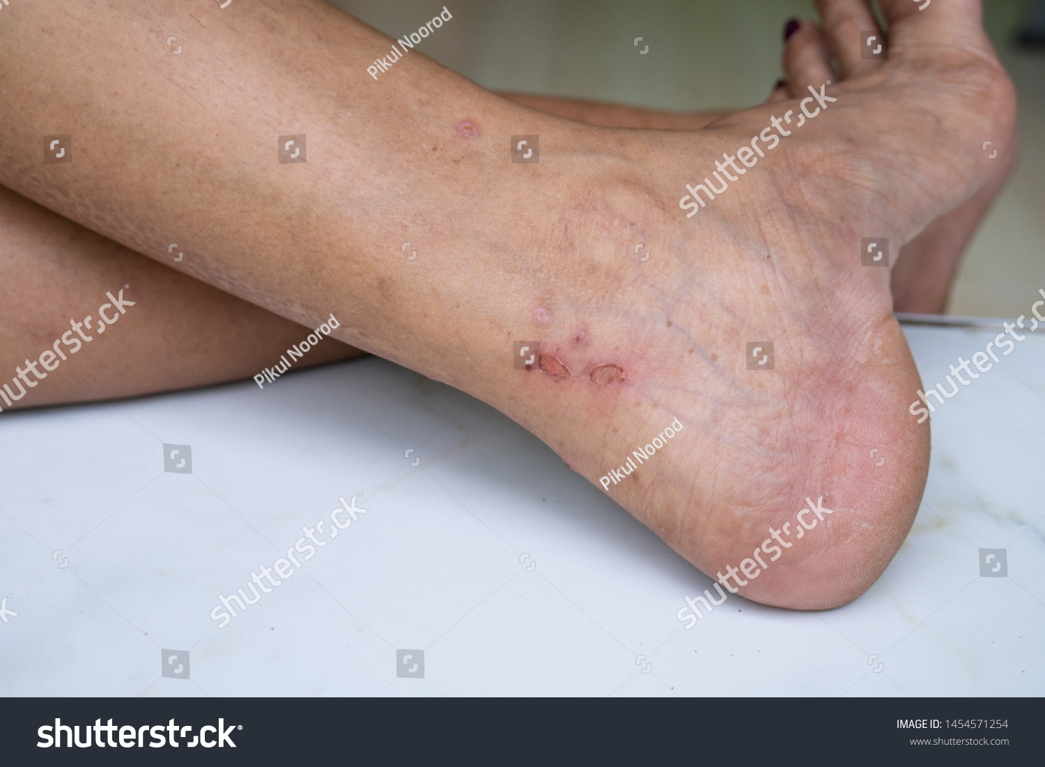 Lesions Caused By Rashes Leg Stock Photo Shutterstock