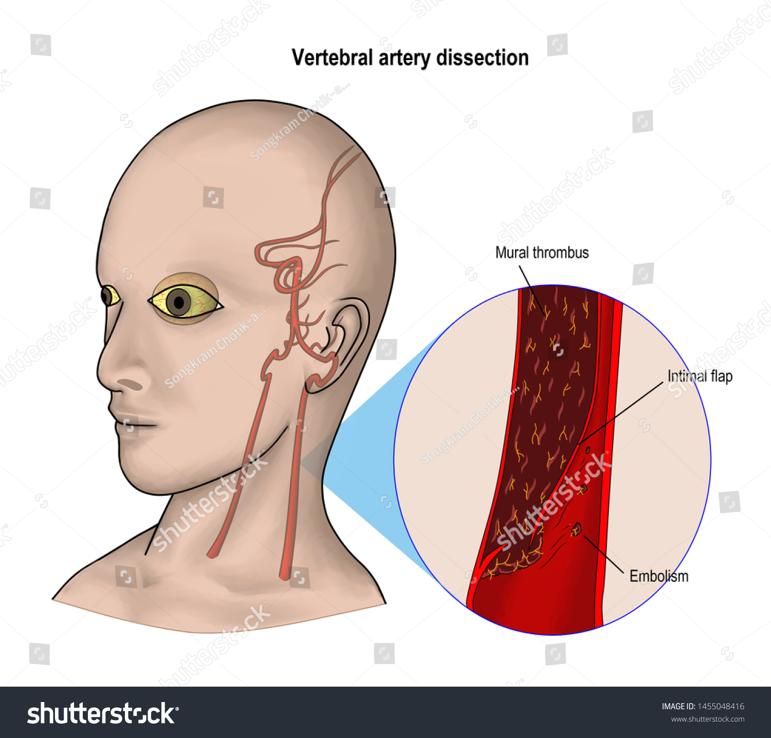 Vertebral Artery Dissection Tearing Wall Vertebral Stock Illustration