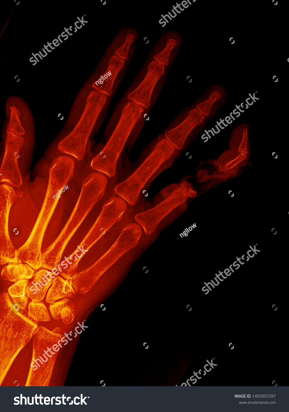 Manus X Ray Anatomy Radiology Radiographic Stock Photo 1459397297 ...