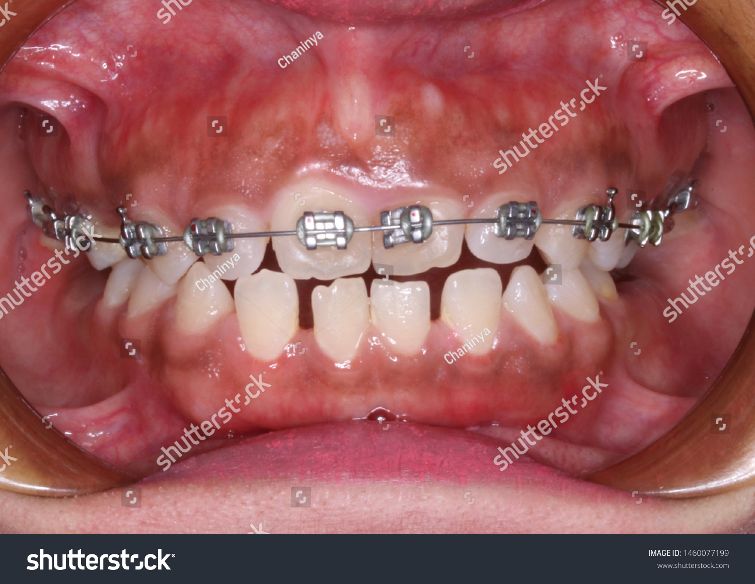 Orthodontic Treatment Malocclusion Teeth Stock Photo 1460077199 ...