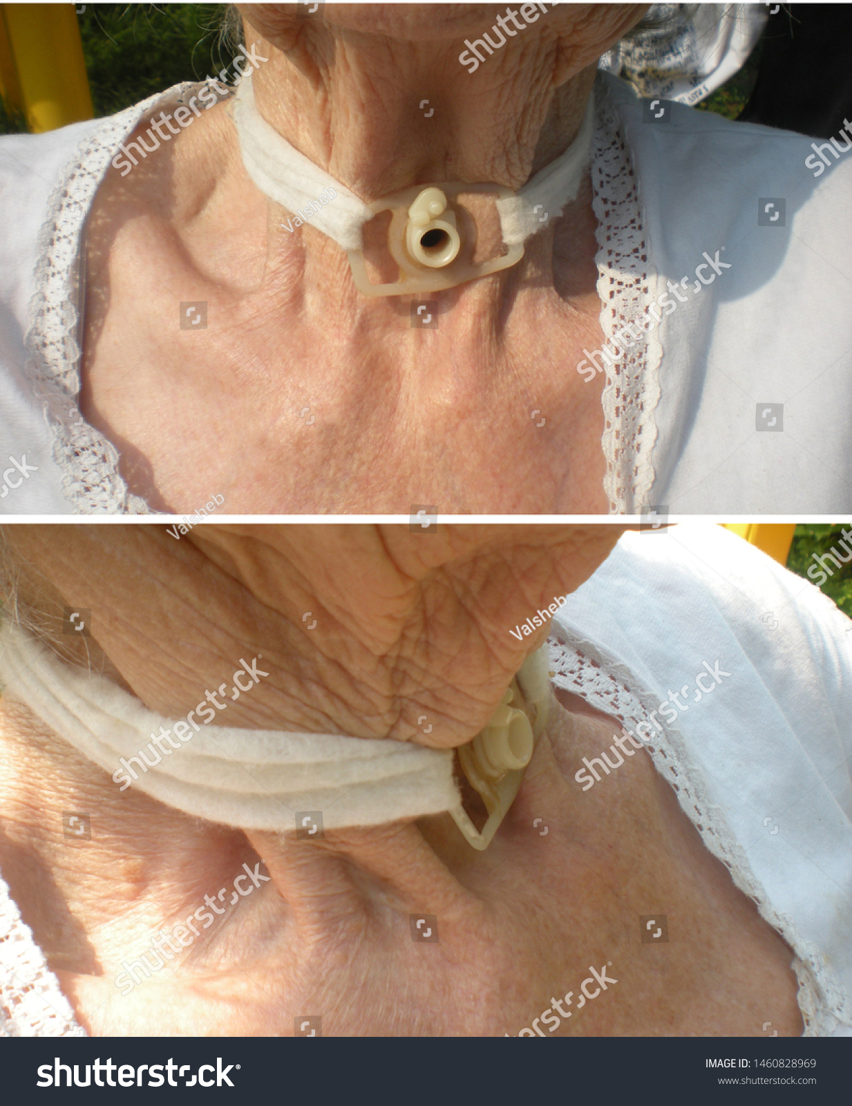 After Thyroid Surgery Stock Photo