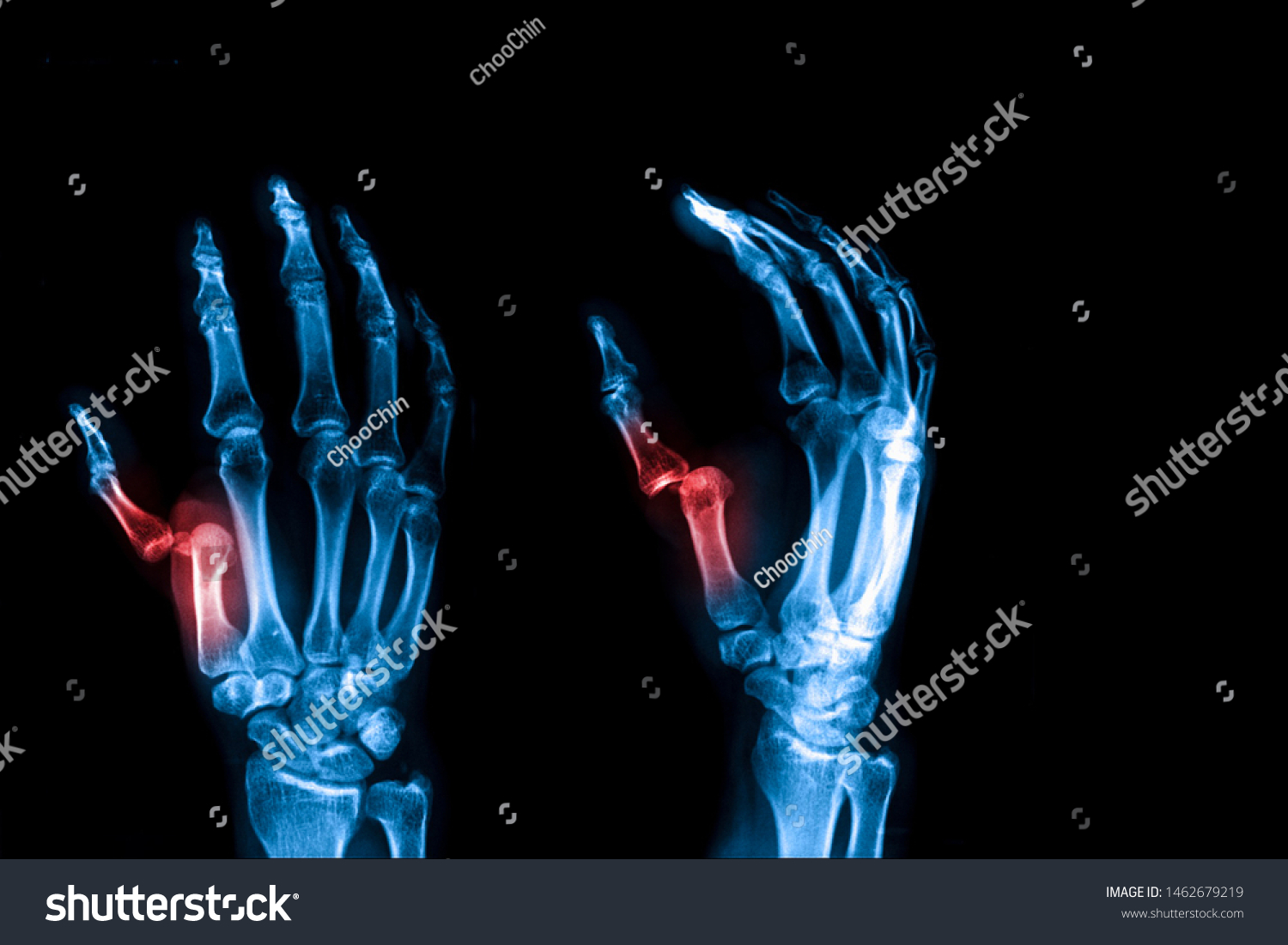 2,222 Thumb fracture body Images, Stock Photos & Vectors | Shutterstock