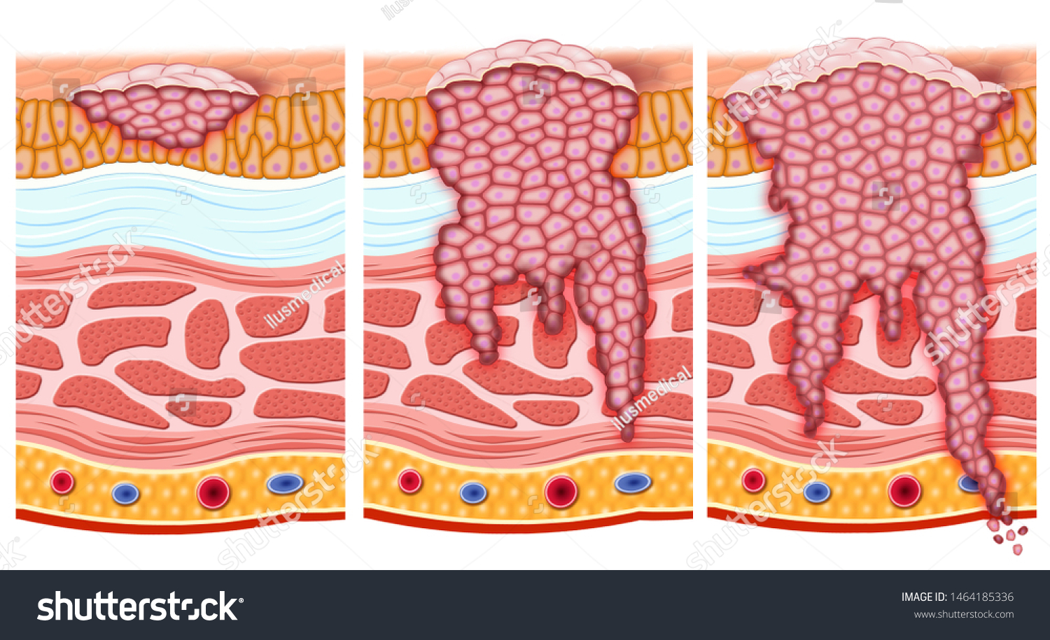 Schematic Illustration Showing Different Stages Bladder Stock ...