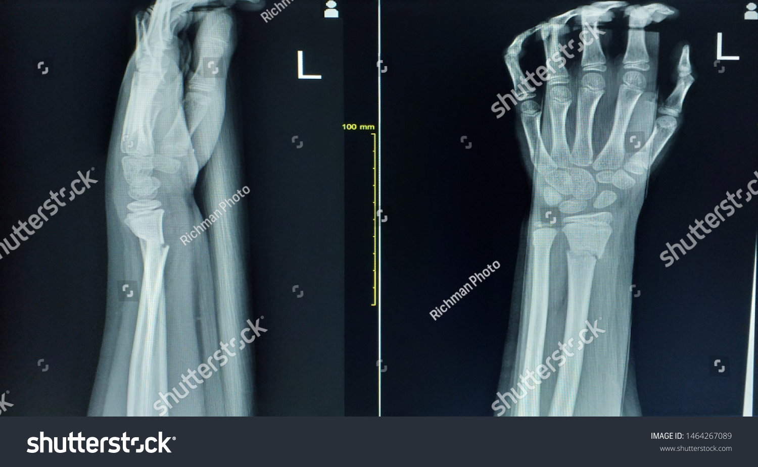 Xray Wrist Jointaplateralcomplet Bony Fracture Bony Stock Photo ...