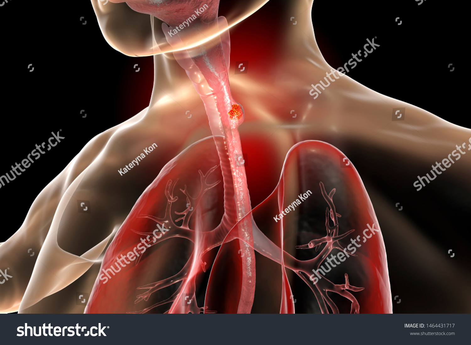 cancer of esophagus pathophysiology