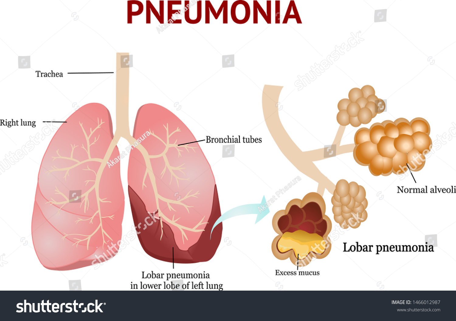 Pneumonia Lobar Pneumonia Isolated Vector Illustration Stock Vector ...