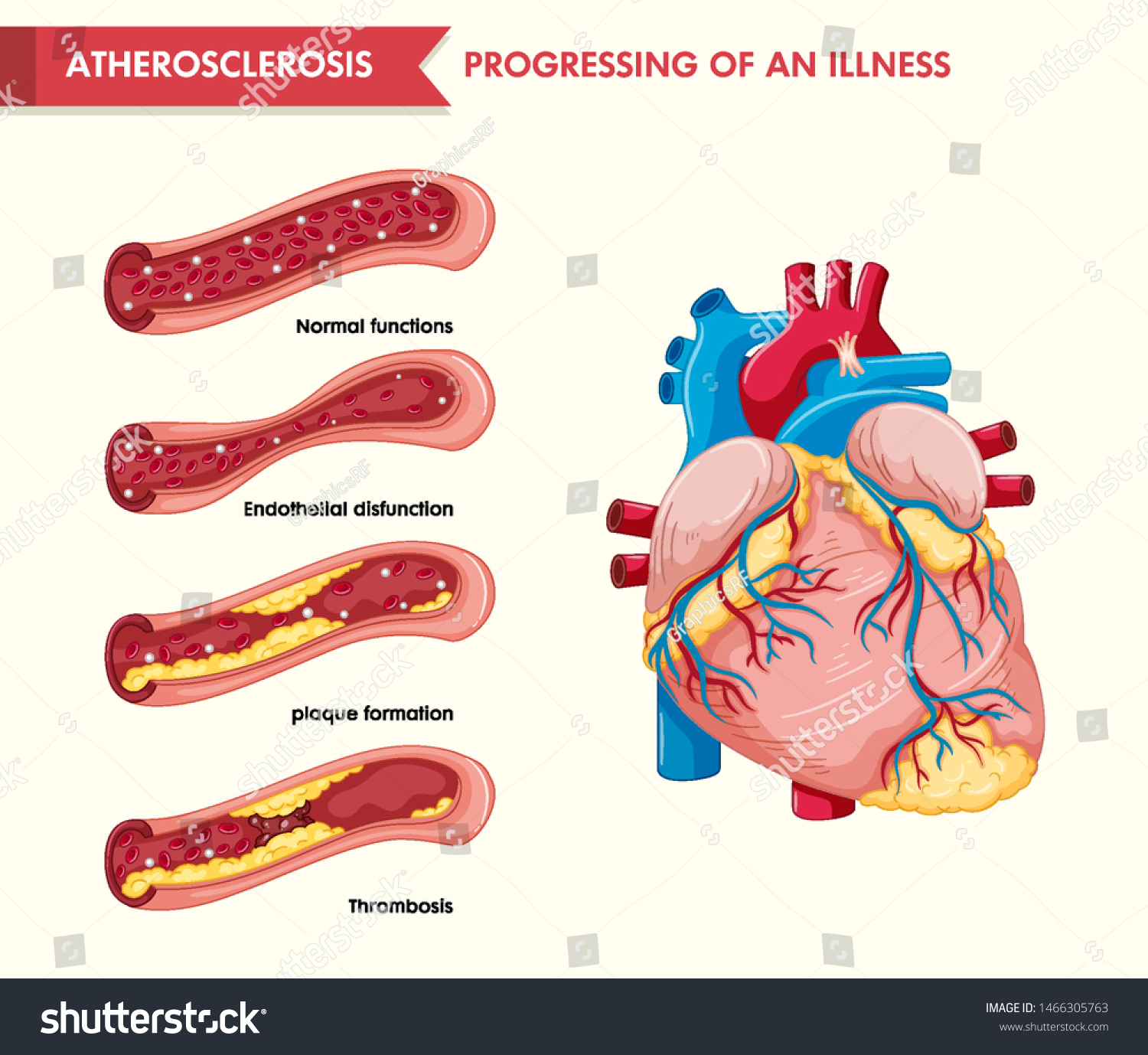 Scientific Medical Illustration Atherosclerosis Illustration Stock ...