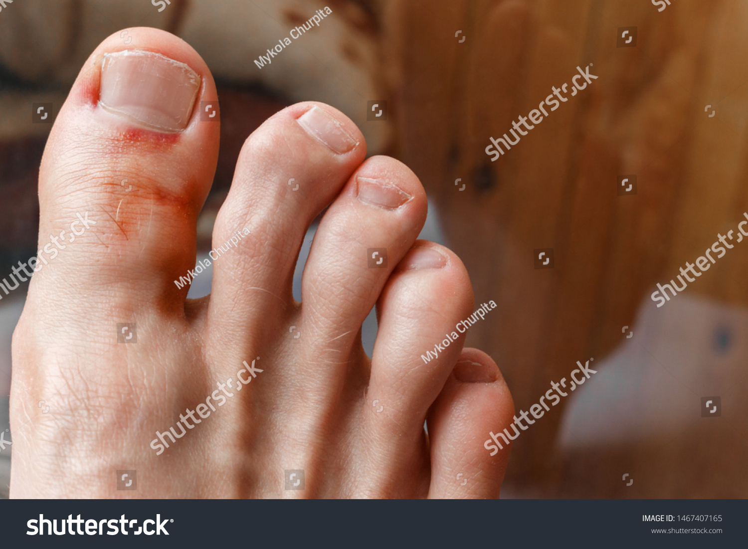 Big Toe Bruise Fracture Curvature Toes Stock Photo 1467407165