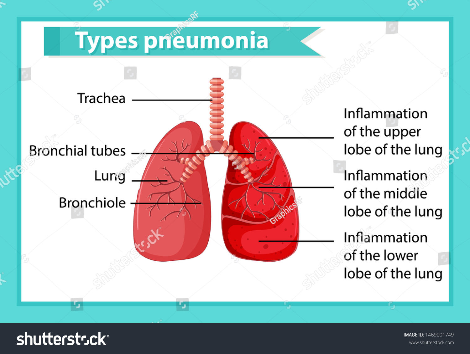 Scientific Medical Illustration Pneumonia Illustration Stock Vector ...