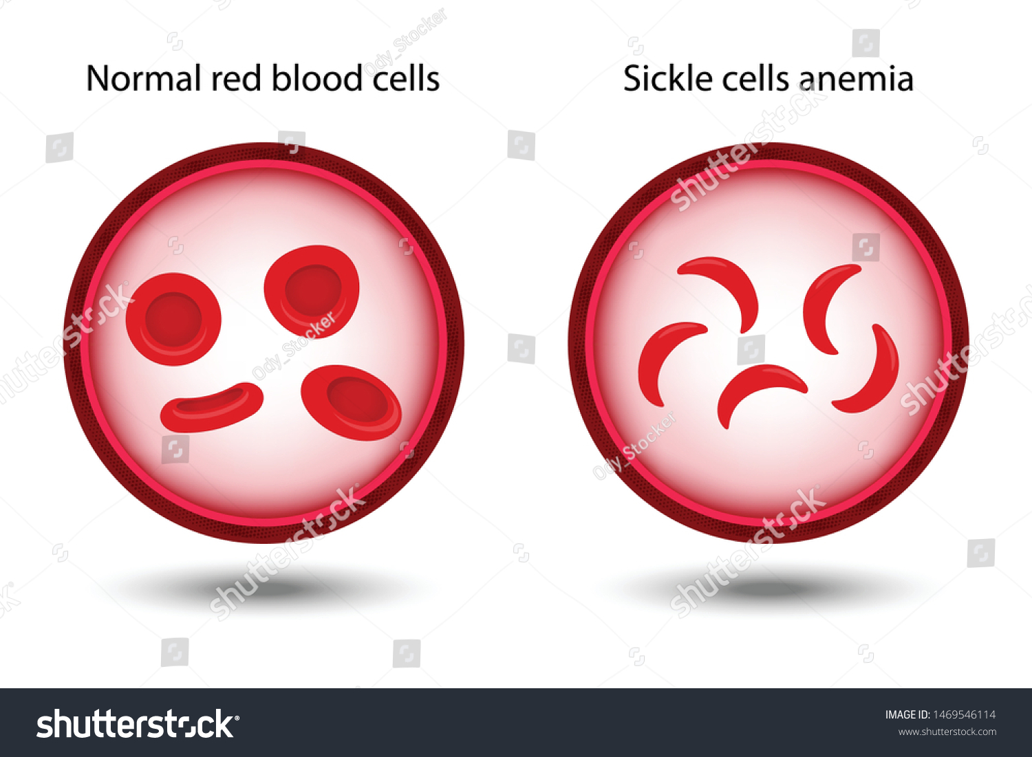 Comparison Between Normal Red Blood Cells Stock Vector (Royalty Free ...