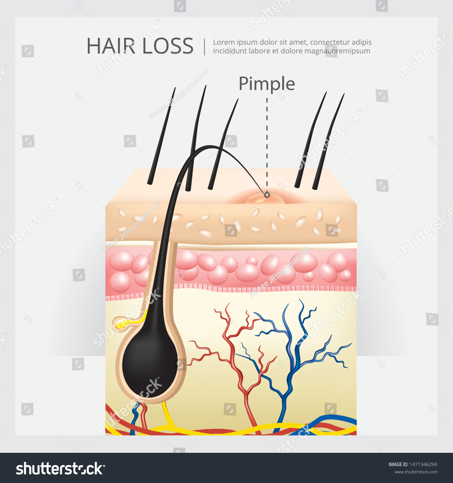 Hair Loss Structure Vector Illustration Stock Vector (Royalty Free ...