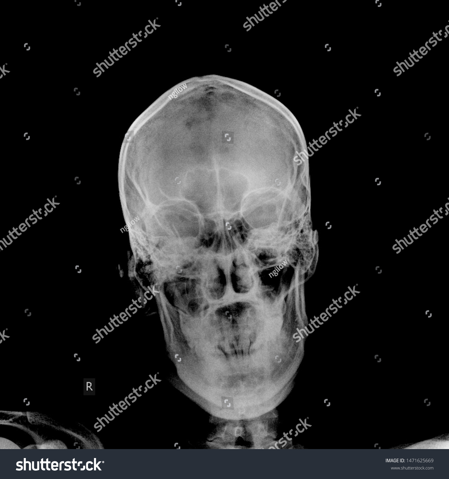 Xray Shot Skull Radiology Scan Human Stock Photo 1471625669 | Shutterstock