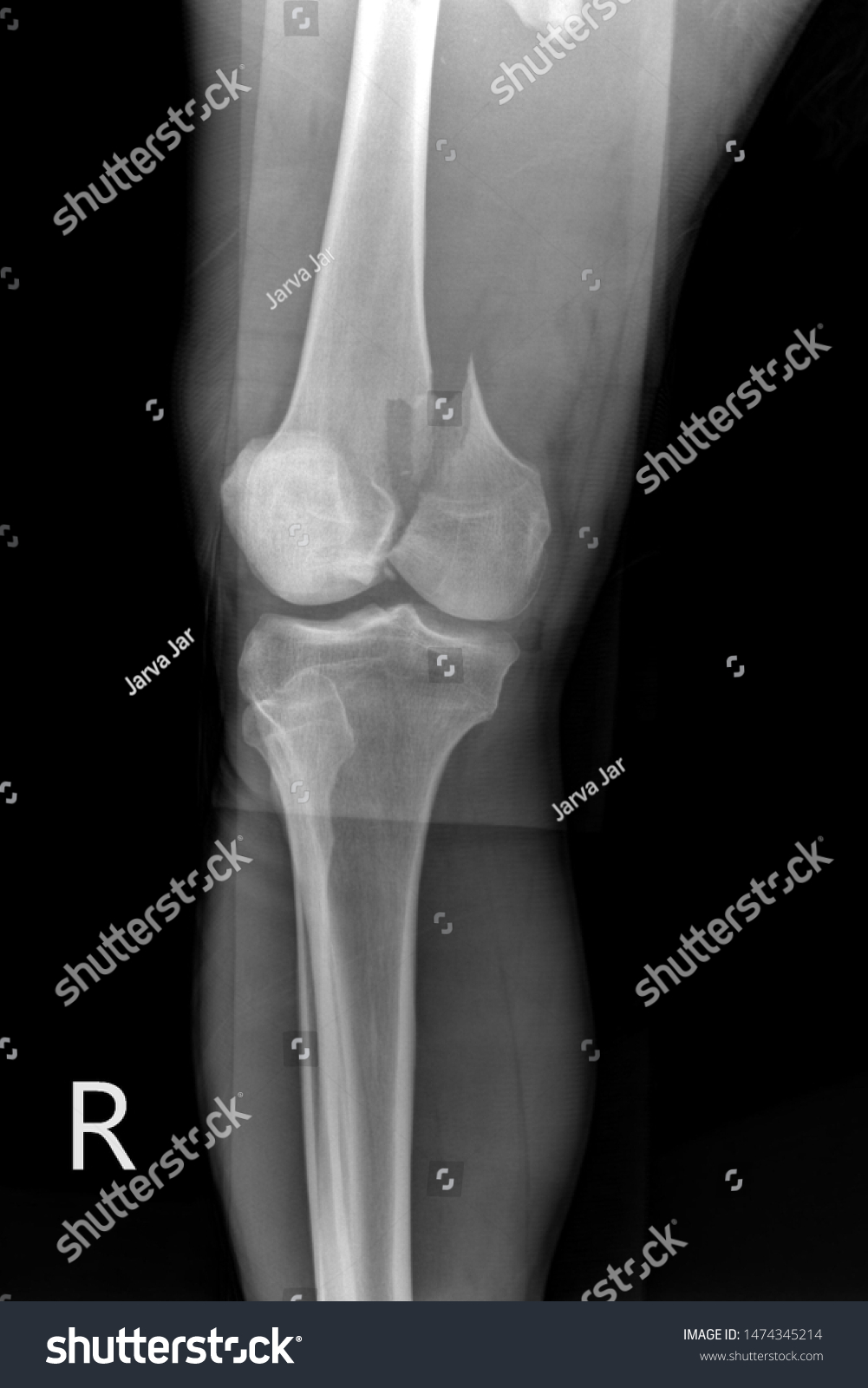 Xray Image Show Closed Fracture Knee Stock Photo 1474345214 | Shutterstock