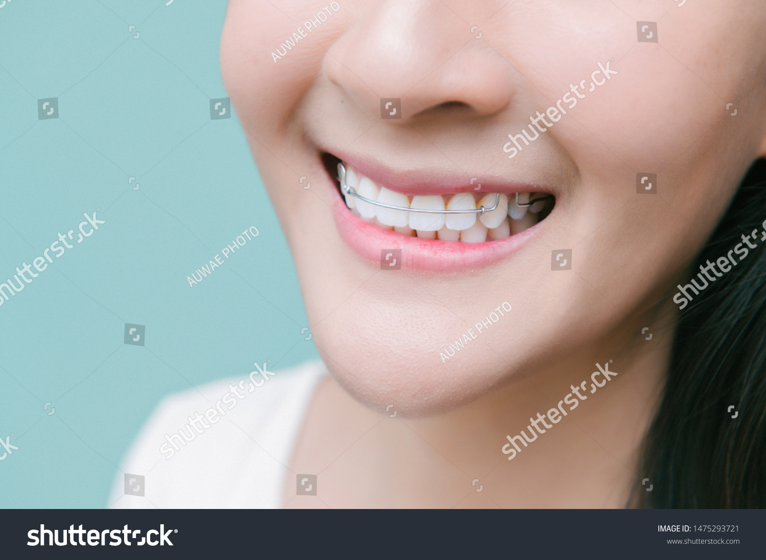 2,173 Wearing Retainer Images, Stock Photos & Vectors | Shutterstock