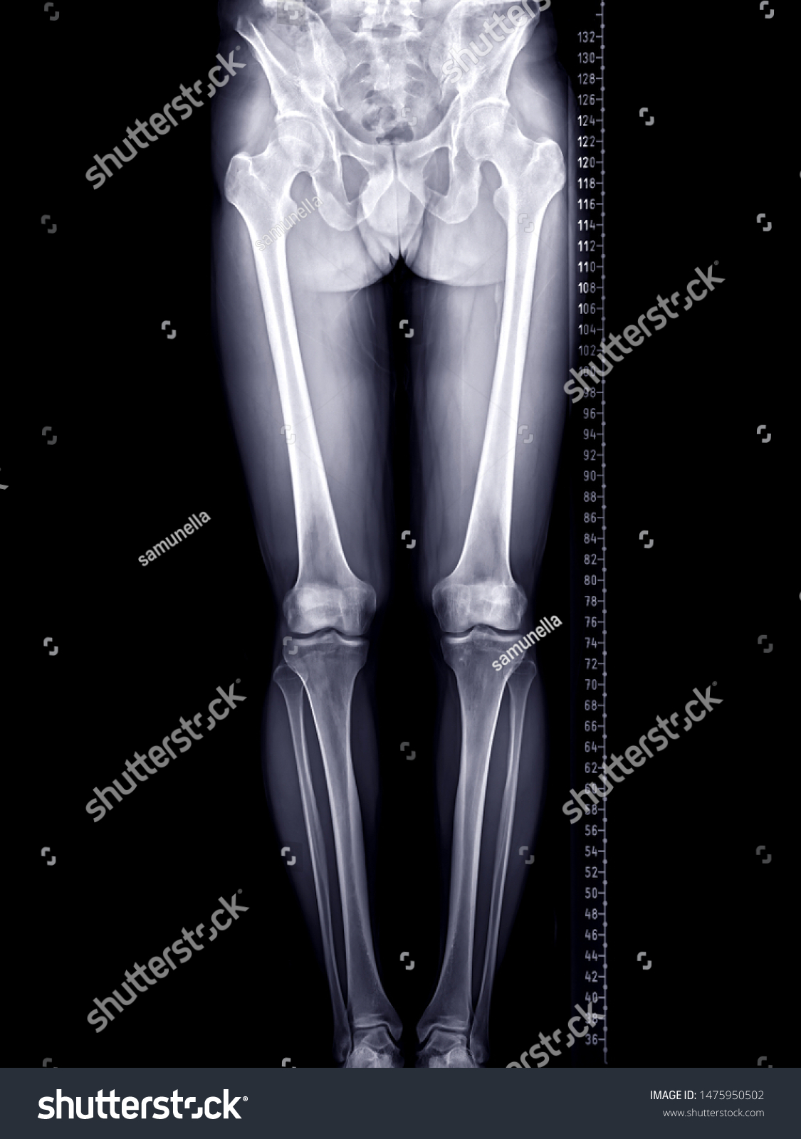 Scanogram Lower Limb Xray Image Total: Stockillustratie 1475950502 ...