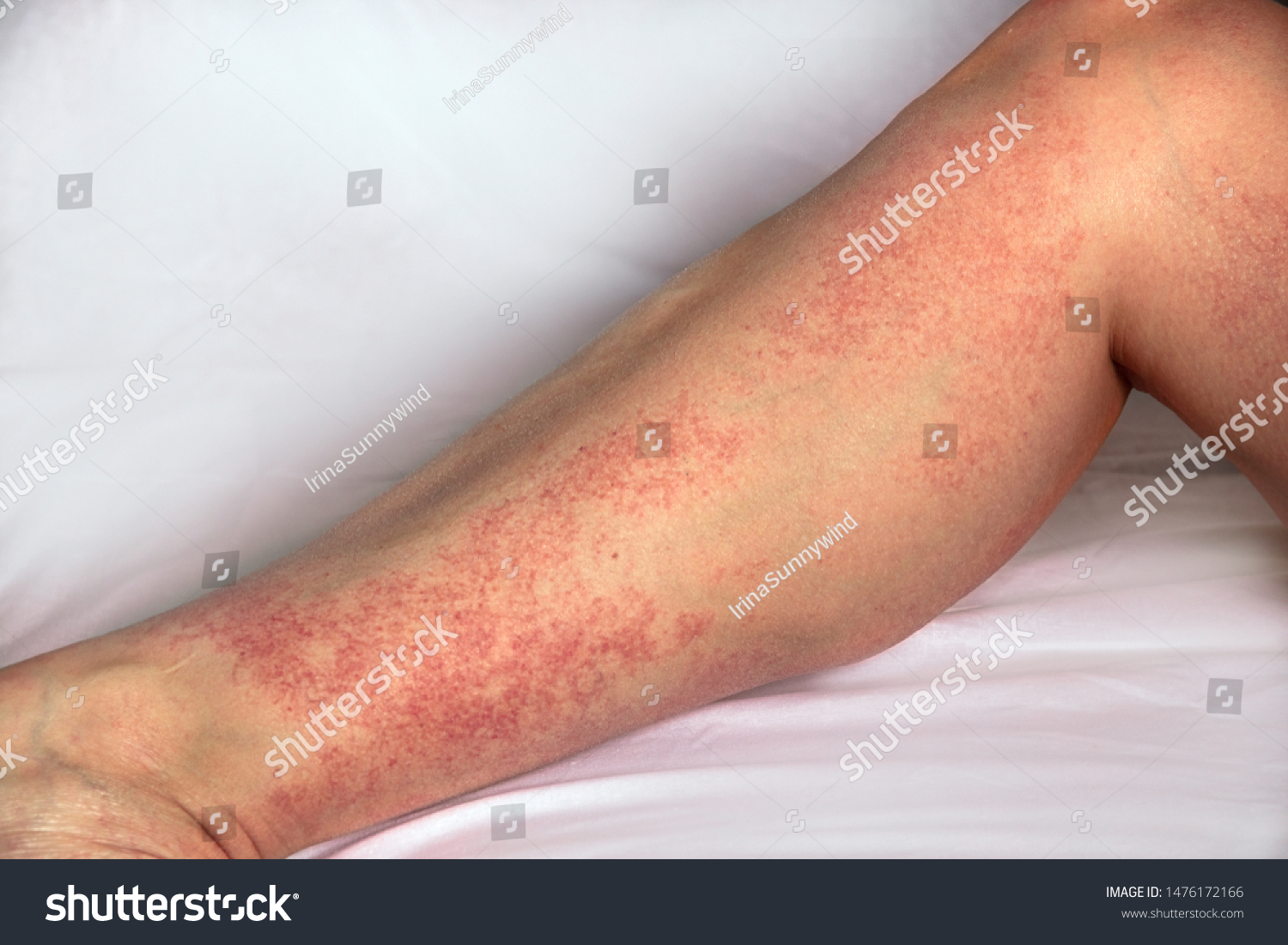 Strong Allergic Rashes On Leg Impaired Foto Stock Shutterstock