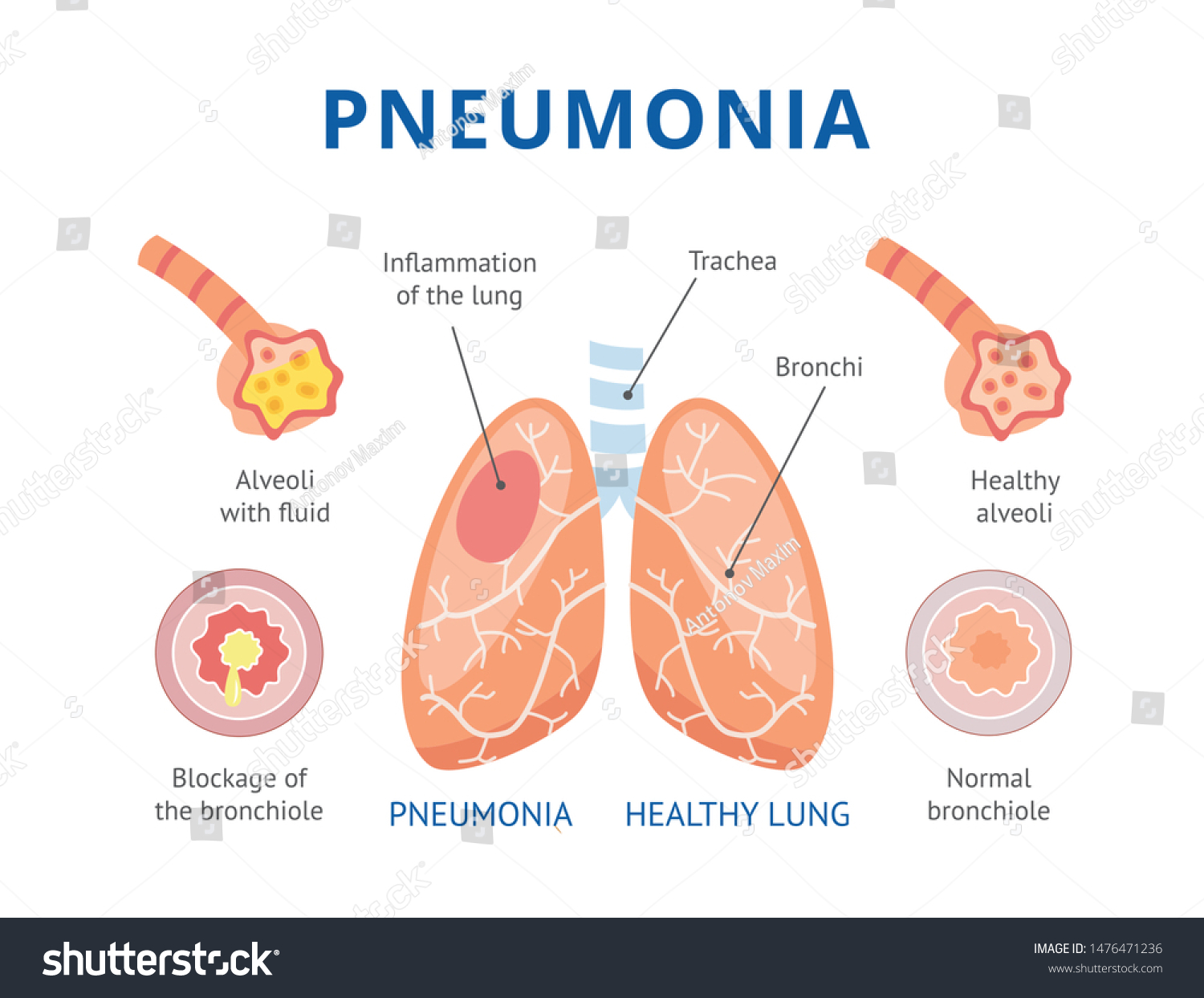 Medical Infographics Human Pneumonia Lungs Healthy 库存矢量图（免版税）1476471236 Shutterstock