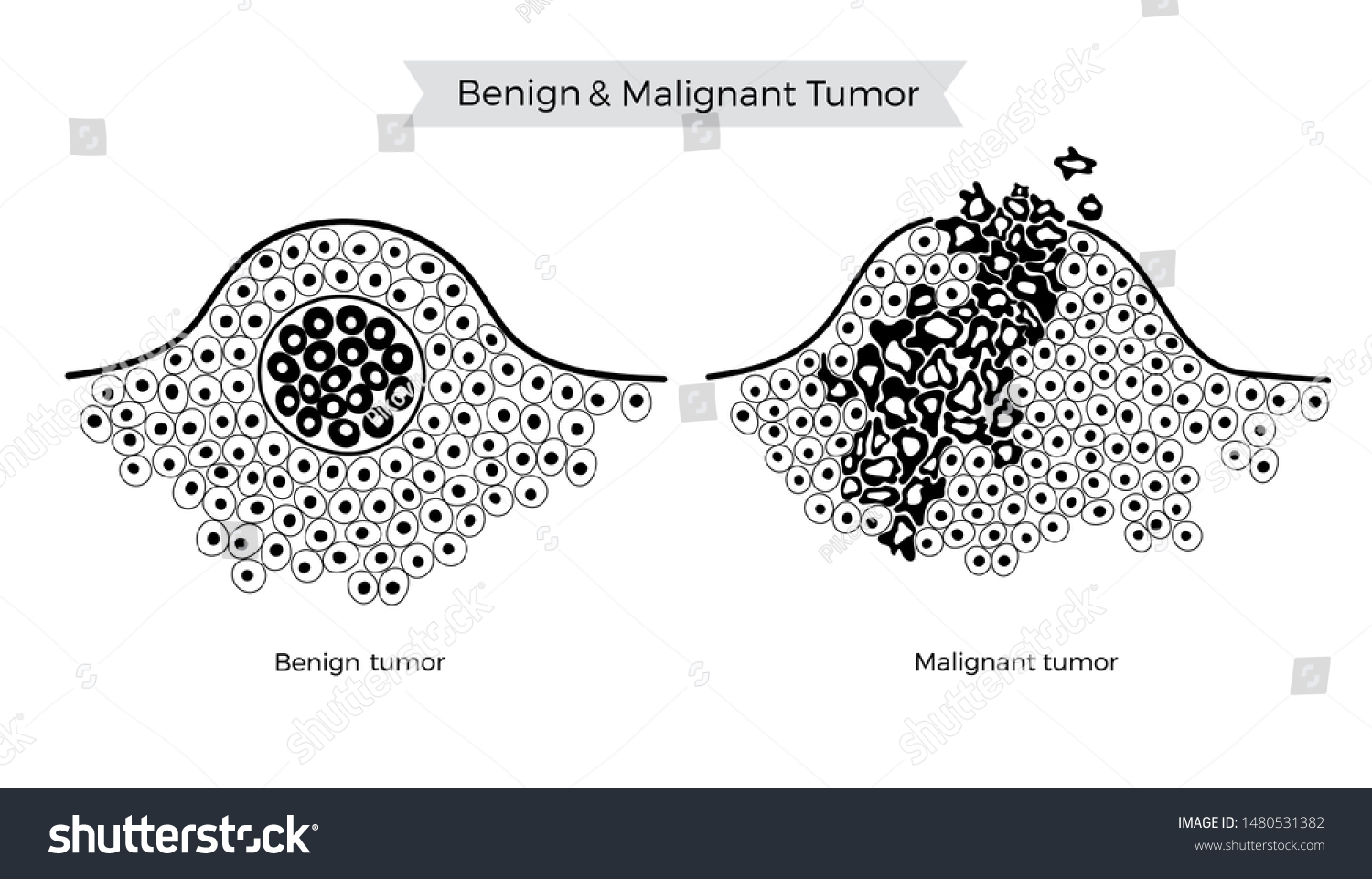 Vector Isolated Illustration Malignant Benign Tumor Stock Vector Royalty Free 1480531382 7703