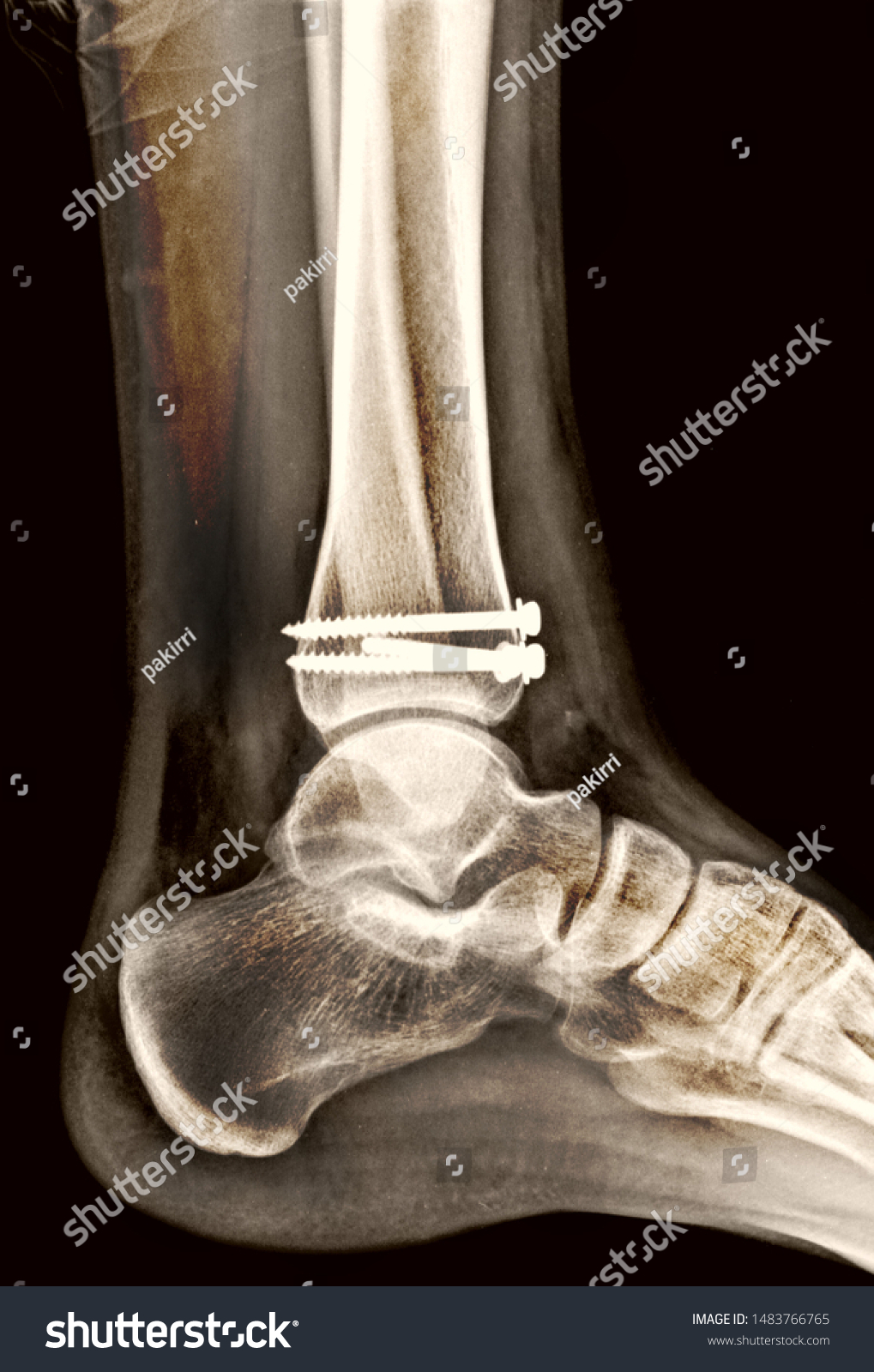 Tibia Perone Fracture Xray Stock Photo 1483766765 | Shutterstock